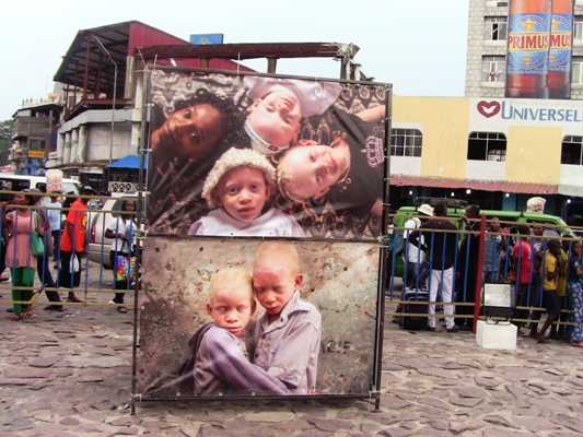 Des enfants albinos de la Fondation Mwimba Texas